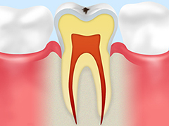 C0初期のむし歯