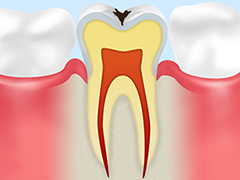 C1エナメル質のむし歯