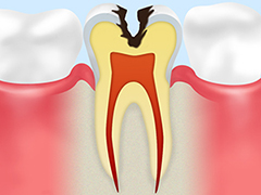 C2象牙質のむし歯