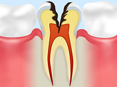 C3神経のむし歯