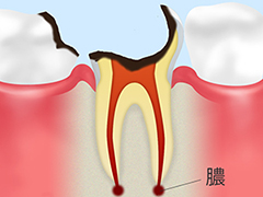 C4重度のむし歯