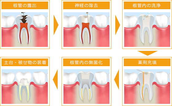 根管治療の流れ