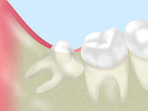 早期に対応すべき「親知らずの治療」