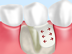 歯周外科治療（フラップ手術・GTR法）