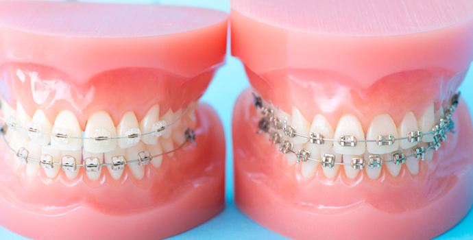 歯並びのお悩みは「矯正歯科」